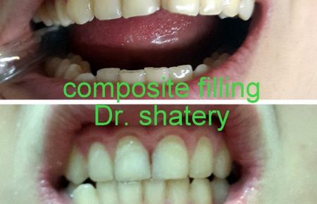 #ترمیم_کامپوزیت#زیبایی