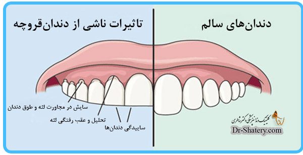 گیرکردن دندان ها در شب(دندان قروچه)