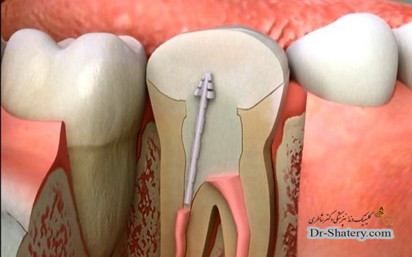 عصب کشی دندان و درمان ریشه