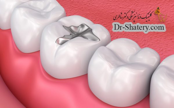 بررسی کلینیکی عملکرد و بهداشت مواد دندانی جدید، به نام بیودنتین، در ترمیم دندان های خلفی