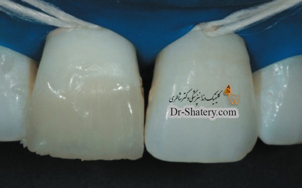 ارتباط تست های آزمایشگاهی بررسی خواص ادهزیو ها و کامپوزیت های دندانی