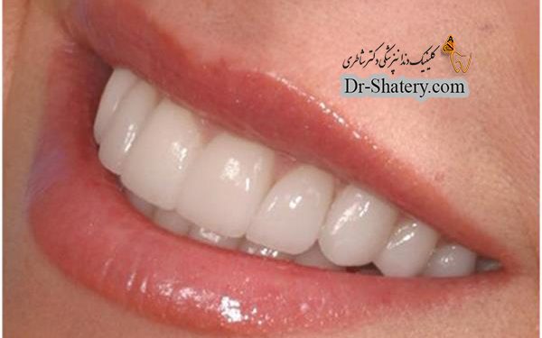 علت و ضرورت زیبایی دندان چیست ؟