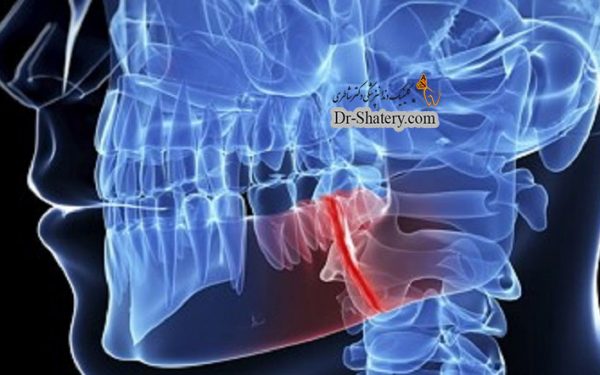 پوکی استخوان، استخوان های فک ، ببماری های پریودنتال