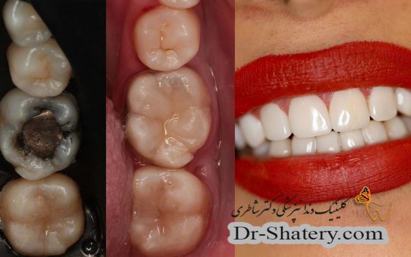 مقایسه کامپزیت و آمالگام