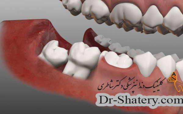 مشکلات دندان نهفته در فک