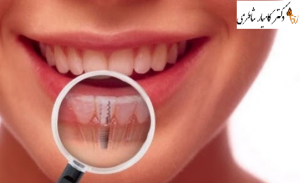 تصویر بقای ایمپلنت های دندان های مجاوردر بیماران پیش دیابتی و افراد سالم از نظر بدنی در پنج سال گذشته