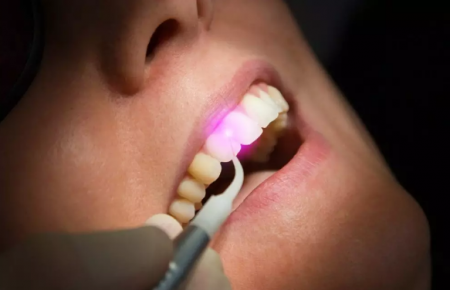 لیزر در دندانپزشکی یک مطالعه مروری